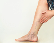 understanding the causes and risk factors of varicose veins a comprehensive guide vascular surgery group